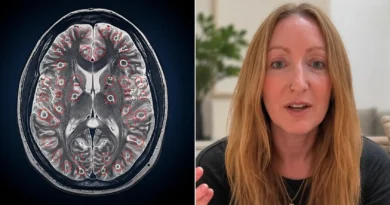 A split image showing a medical brain MRI scan with larvae lesions on the left and a portrait of a 42-year-old British woman, Lawrie Denman, on the right.