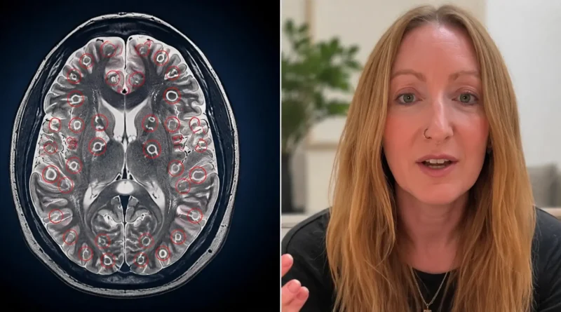 A split image showing a medical brain MRI scan with larvae lesions on the left and a portrait of a 42-year-old British woman, Lawrie Denman, on the right.