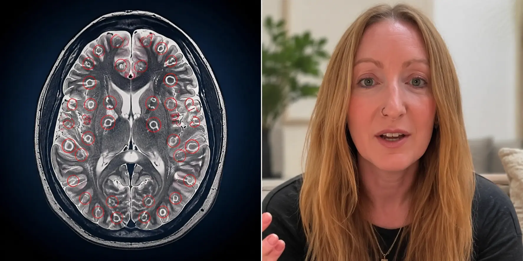 A split image showing a medical brain MRI scan with larvae lesions on the left and a portrait of a 42-year-old British woman, Lawrie Denman, on the right.